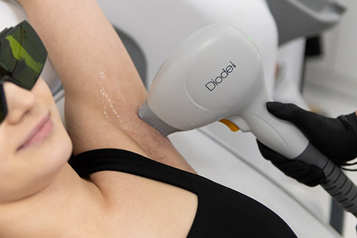 depilacja-laserowa-kielce